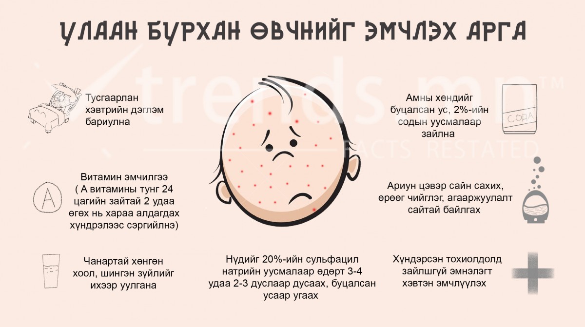 Улаанбурхан өвчнийг эмчлэх арга | trends.mn
